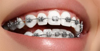 ALWAYS WANTED A BEAUTIFUL SMILE?