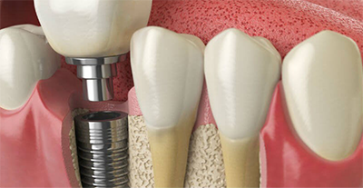 HIGH QUALITY IMPLANTS IN THE UP DENTAL CLINIC