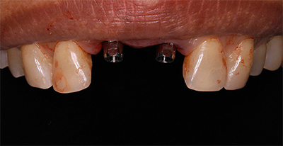 IMPLANT COURSES AT UP