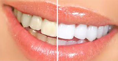 SPECIAL OFFER – UP DENTAL CLINIC OFFERS TOOTH WHITENING AT SPECIAL PRICE FROM VALENTINES DAY UNTIL THE END OF THE MONTH