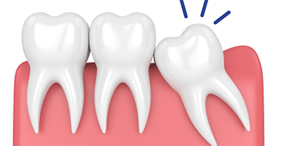 WANTED PATIENTS WHO NEED WISDOM TEETH REMOVED