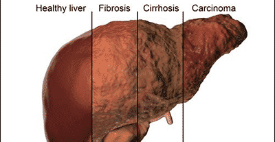 FREE SCREENING for Liver Fibrosis will re-start on Tuesday 2nd June 2020