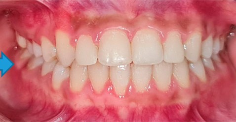 Orthodontic services at UP Dental Clinic “Braces on – Braces off”
