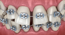 Low Price Orthodontics Treatment Available in the UP Dental Hospital